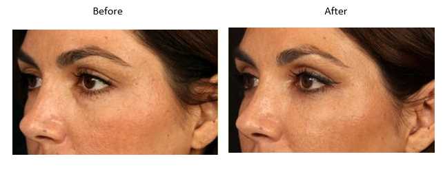 Lower Eyelid Rejuvenation Image