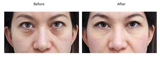 Lower Eyelid Rejuvenation Image