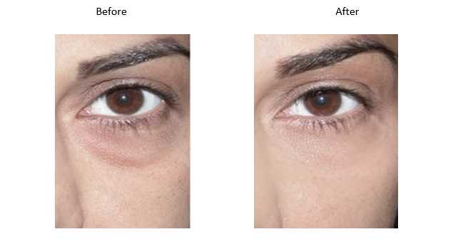 Lower Eyelid Rejuvenation Image