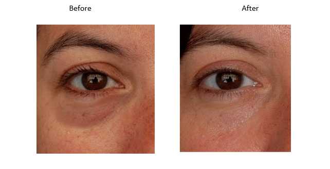 Lower Eyelid Rejuvenation Image