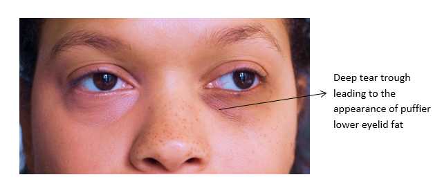 Lower Eyelid Rejuvenation Image