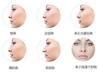 Rhinoplasty