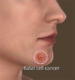 Skin Cancer Surgery