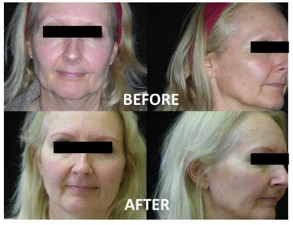 Wrinkle Firming Image