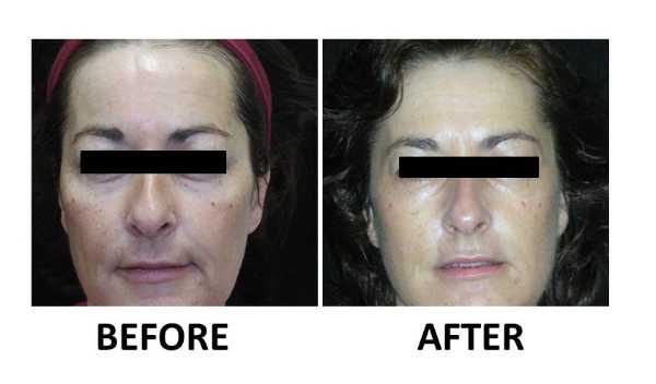 Wrinkle Firming Image